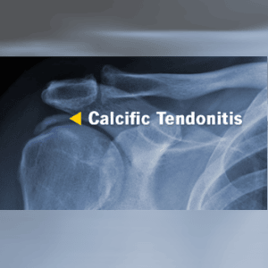 Calcific tendonitis