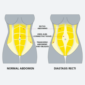 Visual representation of stomach muscles for a normal abdomen and diastasis recti