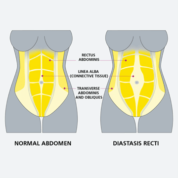 Your stomach muscles during pregnancy - msk